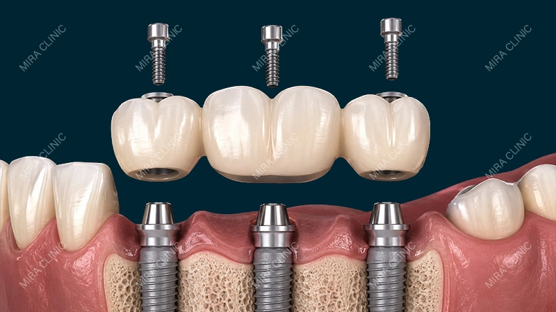 Screw-Retained Implant Bridge